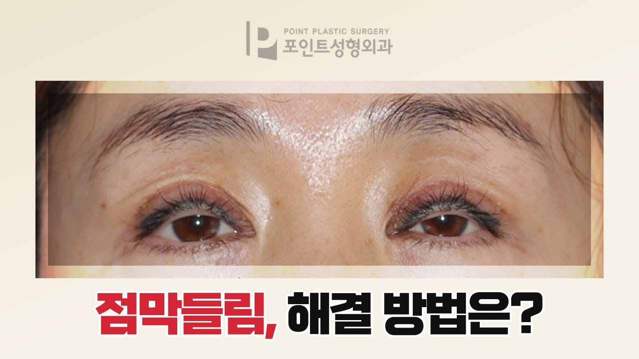 [눈성형/수술전후 ] 점막들림 극한눈 쌍꺼풀수술 실패