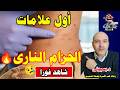 أعراض الحزام الناري وطرق العلاج الفعالة اهلا يا دكتور مرض الزونا 