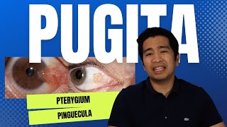 PAANO MAPAPAWALA ANG PUGITA? (PTERYGIUM/PINGUECULA)