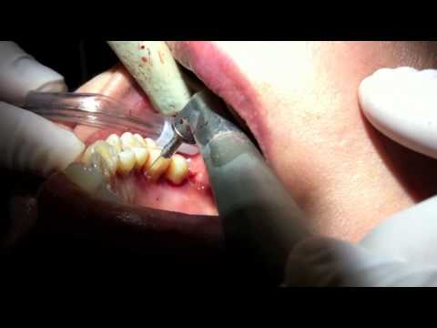 Laser Disinfection of Periodontal Pockets with ER:YAG laser.