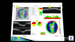 PG Update Series on Glaucoma-How To Read An OCT-Dr. Muralidhar