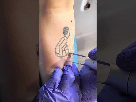 SCAR FREE TATTOO REMOVAL ep7 #short