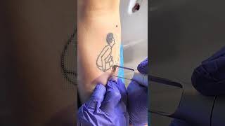 SCAR FREE TATTOO REMOVAL ep7 #short