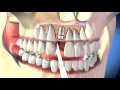 Dental implant - 3D Medical Animation || ABP ©