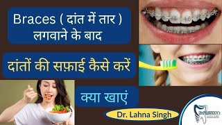 Braces(दांत में तार)लगवाने के बाद दांतों को सफाई कैसे करें,क्या खाएं क्या न खाएं || Dr. Lahna Singh screenshot 2