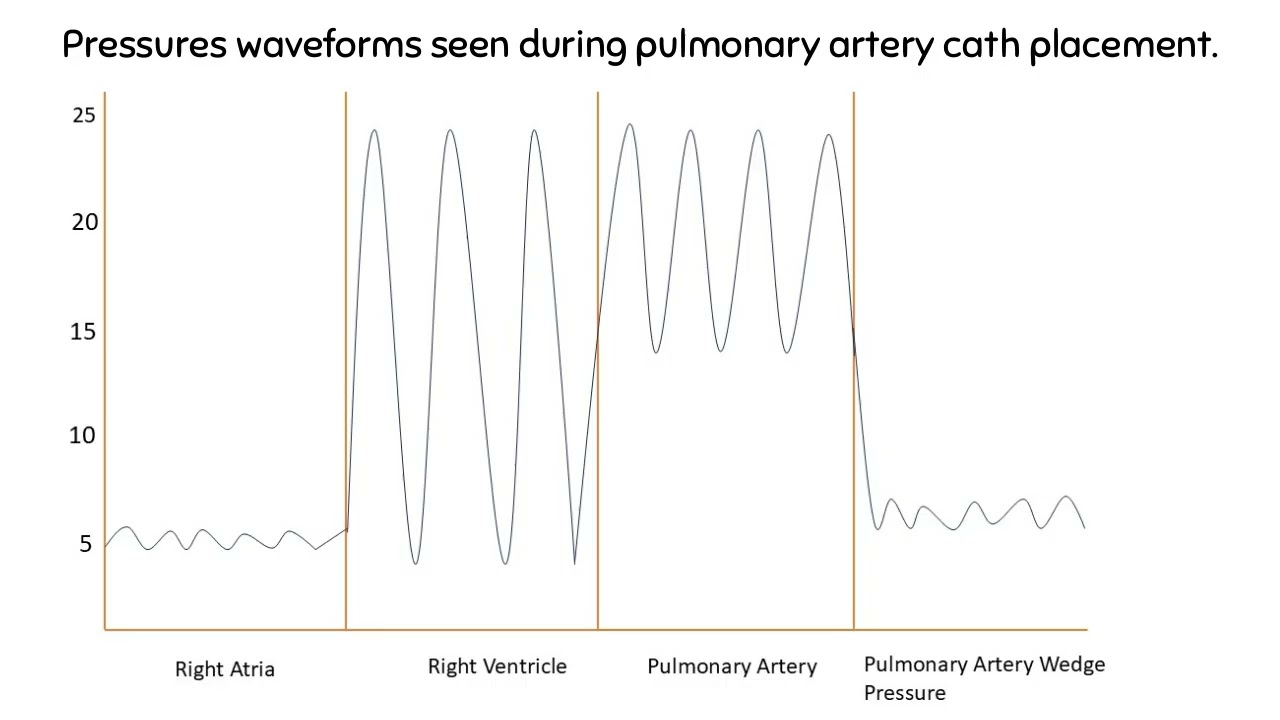 Pulmonary artery wedge pressure/PAOP graph during PA catheter insertion made simple and easy