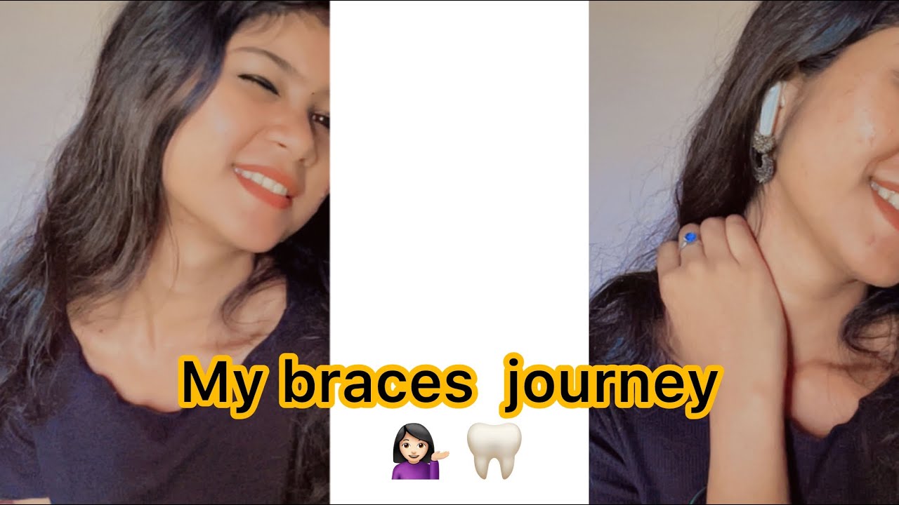 My braces journey story 🦷😬/Malayalam braces 2023teethbraces YouTube
