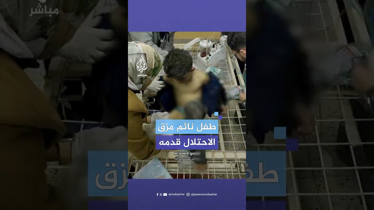 لقطات توثق حالة طفل فلسطيني استيقظ فلم يجد قدمه بعد بترها إثر قصف إسرائيلي استهدف مدينة غزة