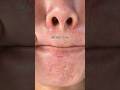 1% salicylic acid = clear pores + controlled oil + open porse #salicylic acid # acne