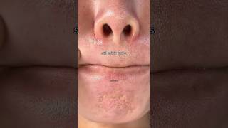1% salicylic acid = clear pores + controlled oil + open porse #salicylic acid # acne