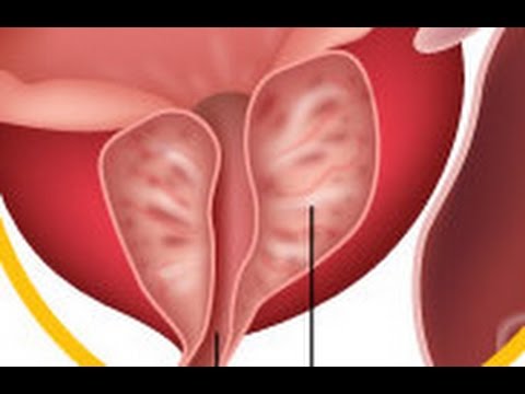 prostatitis fistula