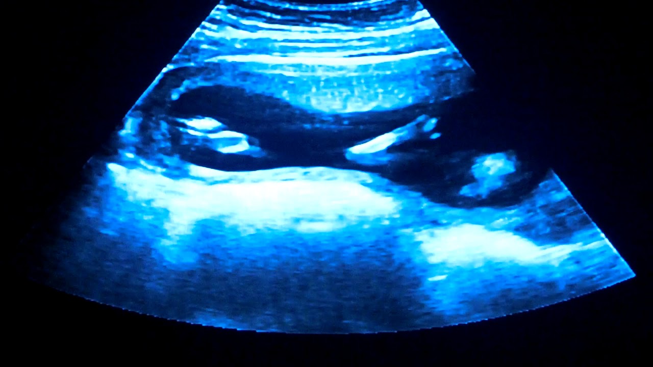 14 weeks Pregnant YouTube