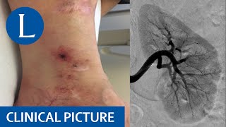 Deficiency of adenosine deaminase 2: a confusing mimic