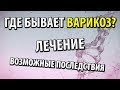 Где бывает варикоз. Правильное лечение и возможные последствия