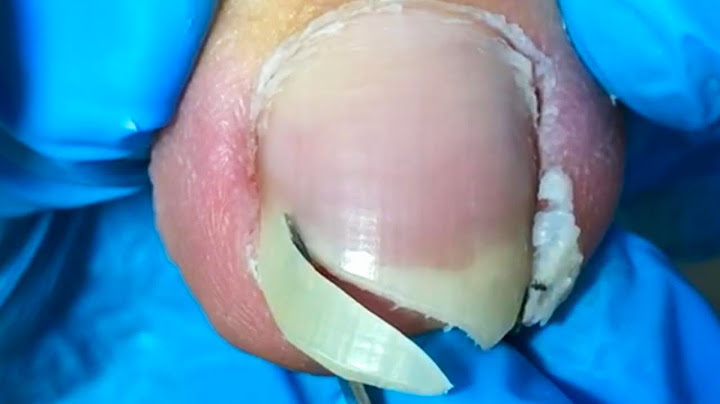 If You Have Very Long Toenails, Just Cut Off The Ingrown Toenails!【Crazy pedicure room】
