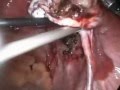 Laparoscopic removal of endometriotic cysts by dr sankar dasmahapatra