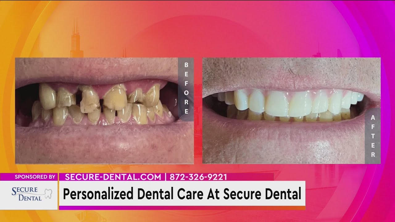 Personalized Dental Care At Secure Dental