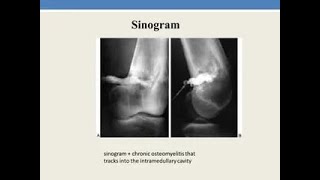 Sinography or Sinogram Radiological Procedure ; Definition, Procedure, Applications, Advantages