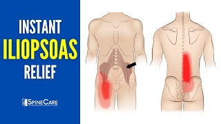 How to Instantly Relieve Iliopsoas Muscle Tightness (AND PAIN!)