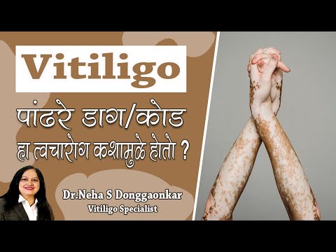 What is Vitiligo  | पांढरे कोड कशामुळे होतो  | Vitiligo Types, Causes & Reason