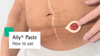 Ally® Paste - Ostomy Paste How to Use screenshot 5