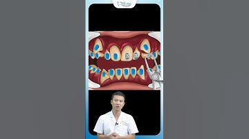 Niềng Răng Lệch Lạc | Bác Sĩ Yên