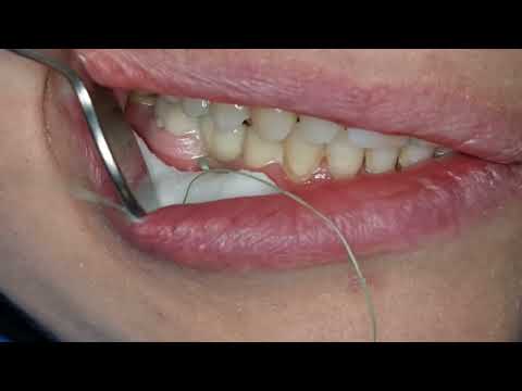 الصاق جسر زركون بغلاس آينومير 