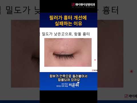 필러가 흉터 개선에 실패하는 이유 #<strong>필러시술</strong> #shorts