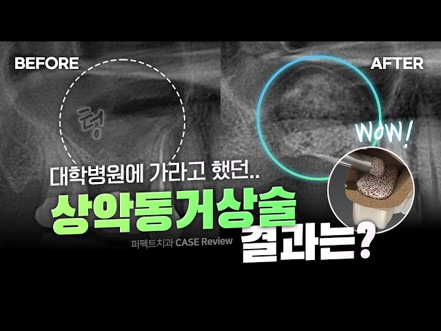 상악동 거상술, 뼈이식 임플란트 대학병원으로 가라고❓