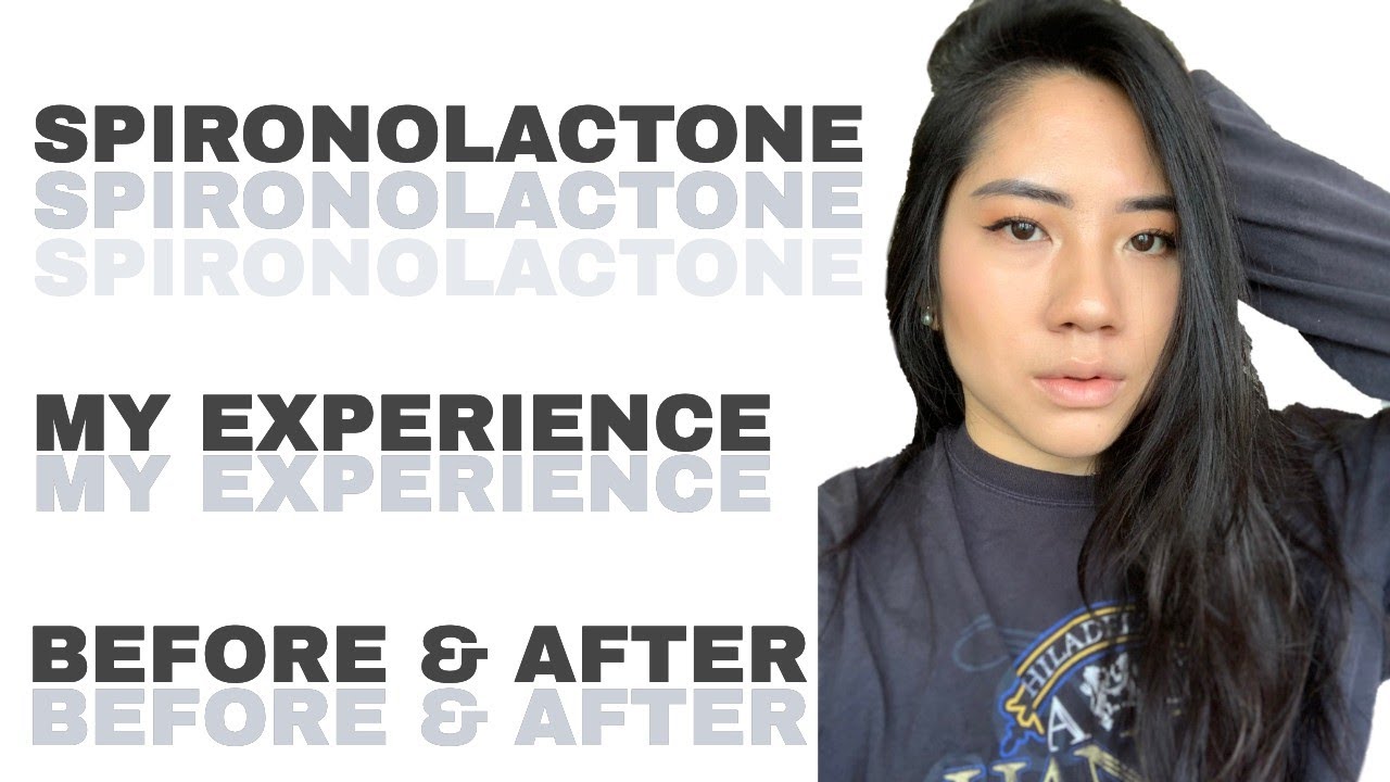 SPIRONOLACTONE CHANGED MY SKIN | My experience | Before & After 9 MONTHS