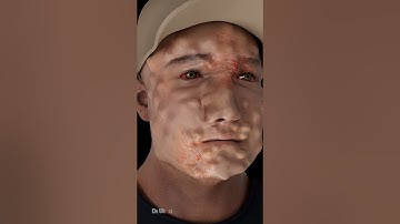 Hoe lepra wordt overgedragen #ziekte #virus #bacterie #korte broek