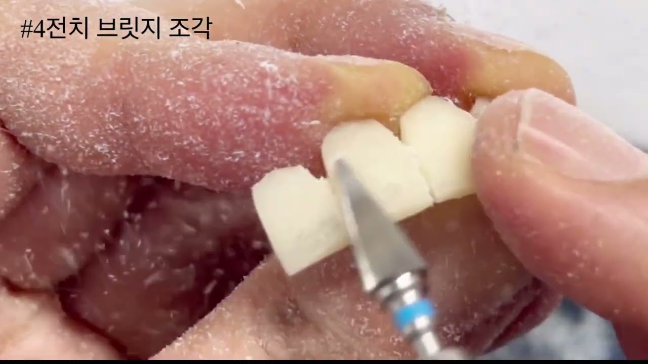 임시치아 4전치 (temporary crown)