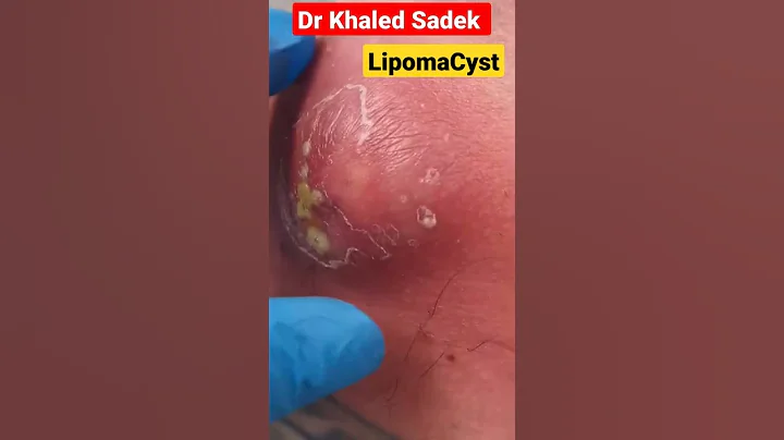 red hot #shorts #cystremoval #blackheads #pimplepopper #drkhaledsadek dr khaled sadek Lipomacyst.com