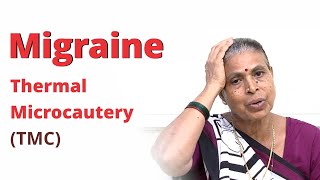 Exceptional Recovery from Migraine by Thermal Microcautery (Agnikarma) | Patient Review