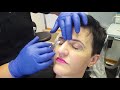 Botox Demonstration - Bridge of Nose