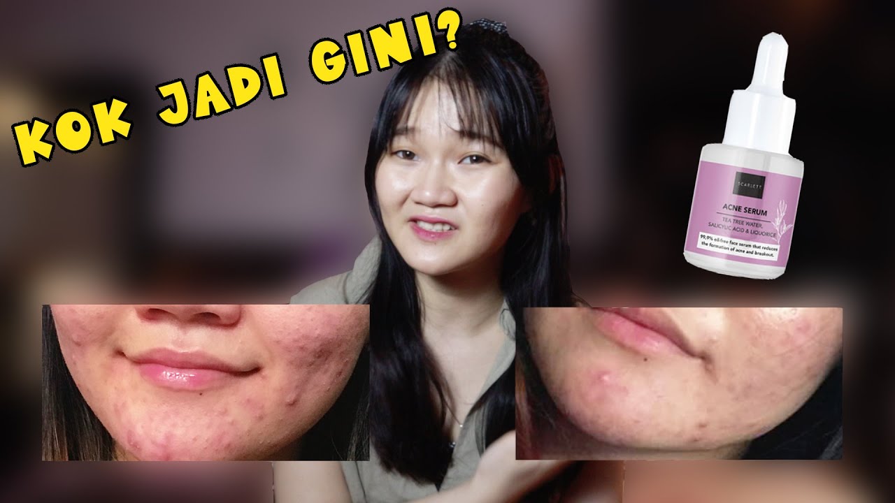 REVIEW JUJUR Acne Serum Scarlett Whitening!