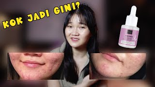 REVIEW JUJUR Acne Serum Scarlett Whitening!