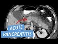 Acute Pancreatitis and Complications on CT