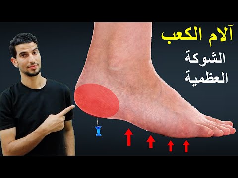 تخلص من الشوكة العظمية والام كعب القدم في 3 ايام
