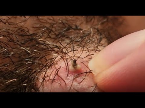 One Tough Ingrown Beard Hair!