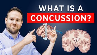 What is a Concussion? | Concussion Patient Education Series | Ep. 1