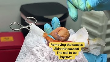 INGROWN TOENAIL REMOVAL 