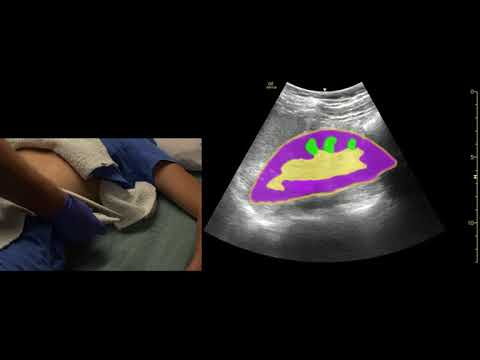 Kidney Ultrasound Scanning