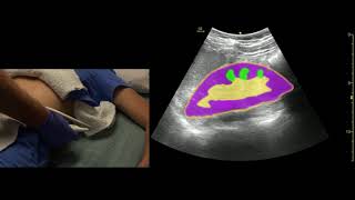 Kidney Ultrasound Scanning Technique