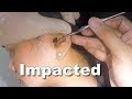 Girl's Impacted Earwax Finally Removed After 5 Days of Earwax Softener