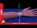 Wrist Fixator Surgery 3D Animation