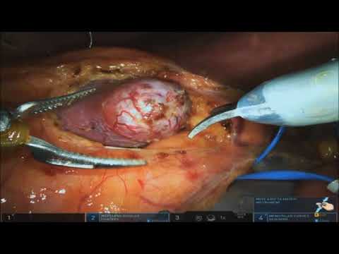 Use of Firefly for Margin Assessment in Robotic Partial Nephrectomy (Differential Fluorescence)