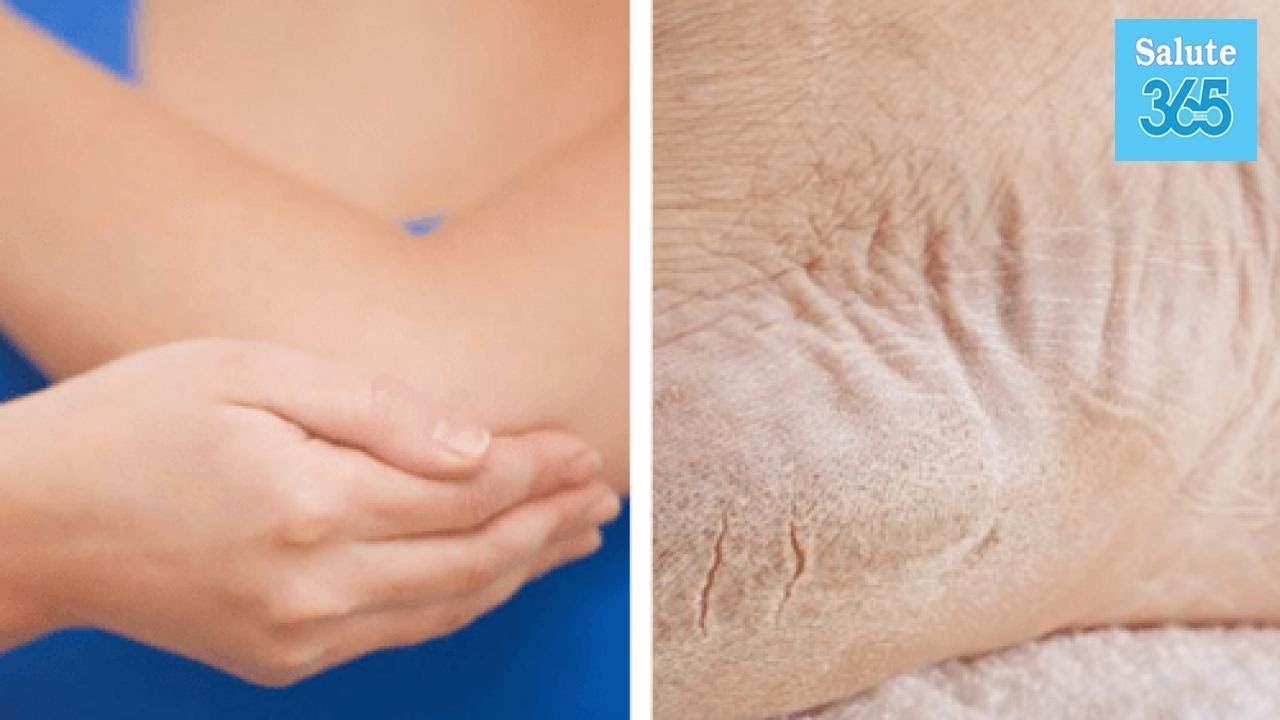 Бородавчатая эпидермофития. Сухие локти у ребенка причины. Сухие локти у ребенка причины. Аллергическая сыпь на локтях. Сухие локти у ребенка причины.