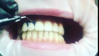 Холодное отбеливание зубов Amazing White Холодное отбеливание зубов Amazing White