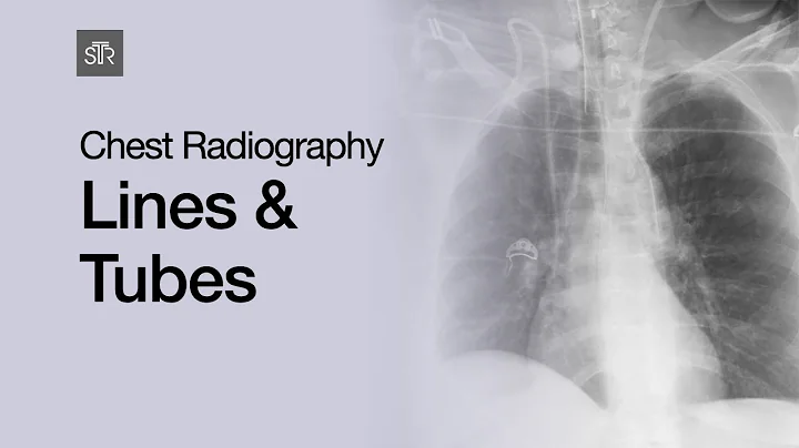 Chest Radiography: Lines & Tubes